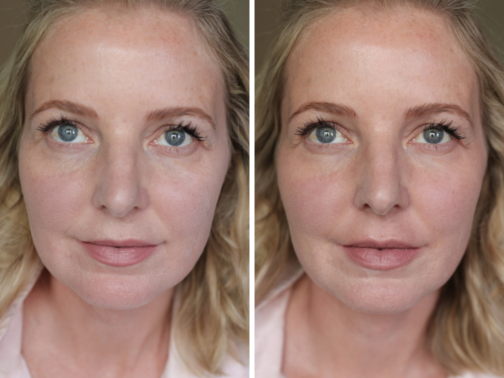 Before and After NuFace Fix featuring the whole face reviewed by beauty blogger Erin busbee of busbeestyle.com