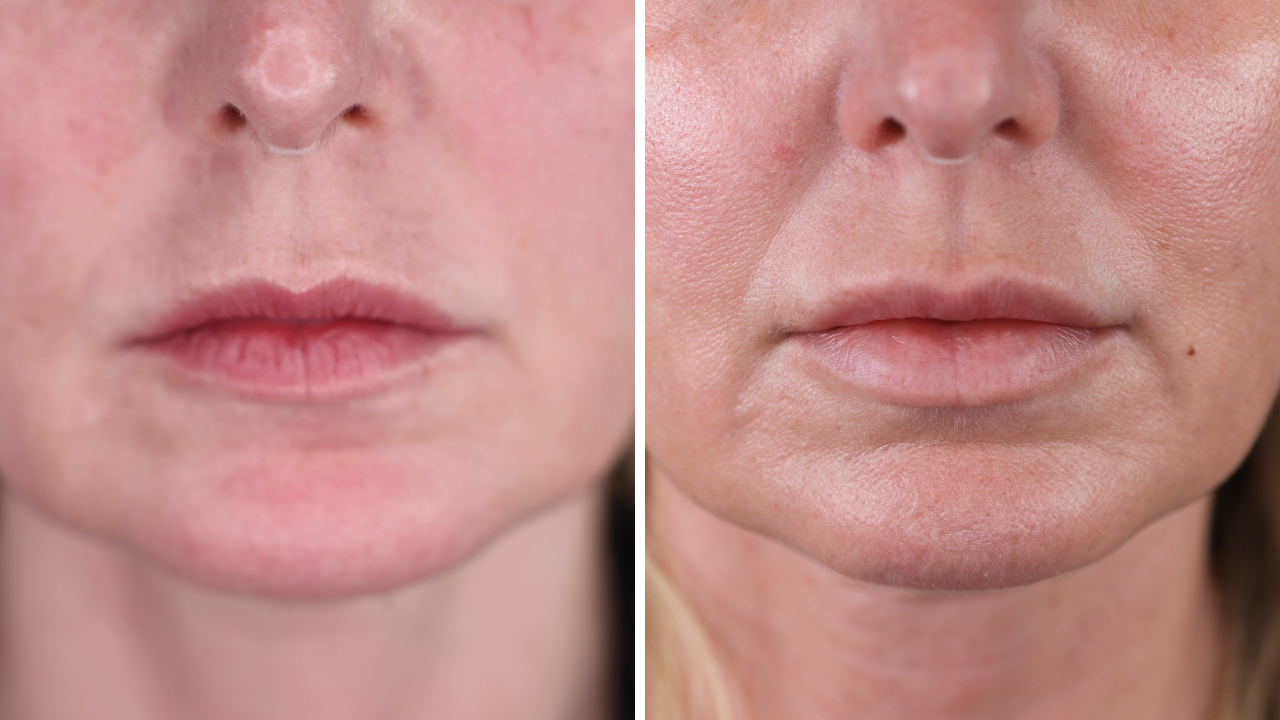 pdo thread lift, botox, lip fillers, ultherapy, ultherapy review, pdo thread lift review, look 10 years younger 