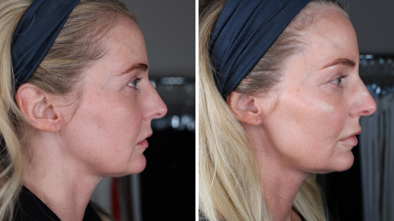 pdo thread lift, botox, lip fillers, ultherapy, ultherapy review, pdo thread lift review, look 10 years younger 
