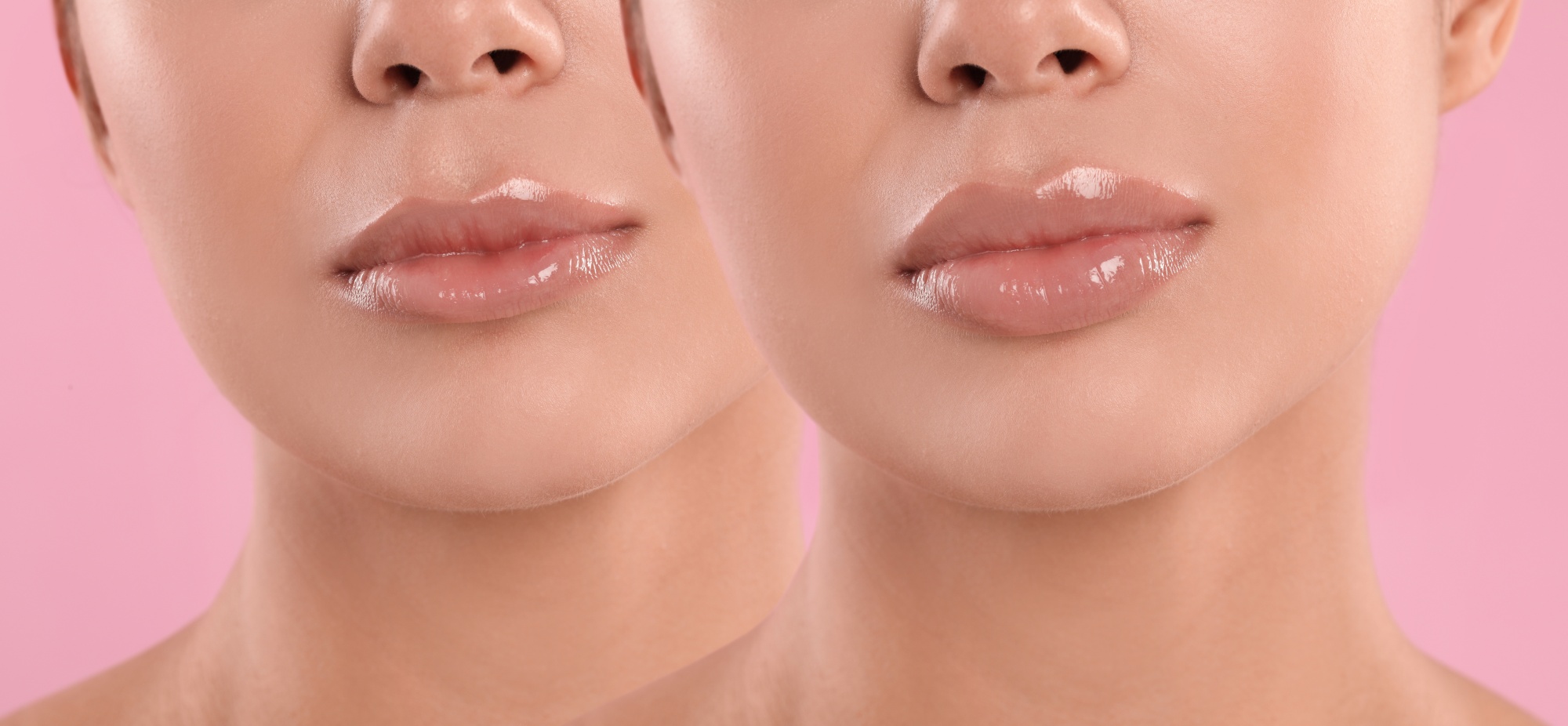 lip before and after procedure fuller more youthful lips