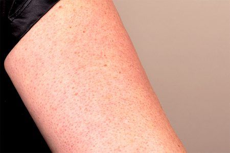arm with keratosis, summer skin problems
