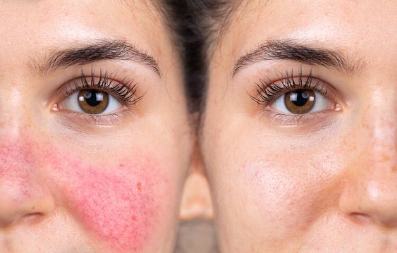 woman's face rosacea on cheeks, summer skin problems