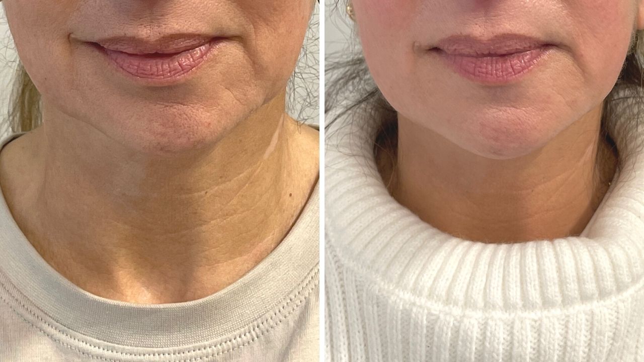 Ultherapy review Francine left view before and after, ultherpay results, ultherapy questions, procedures for younger looking skin, younger skin for women over 40
